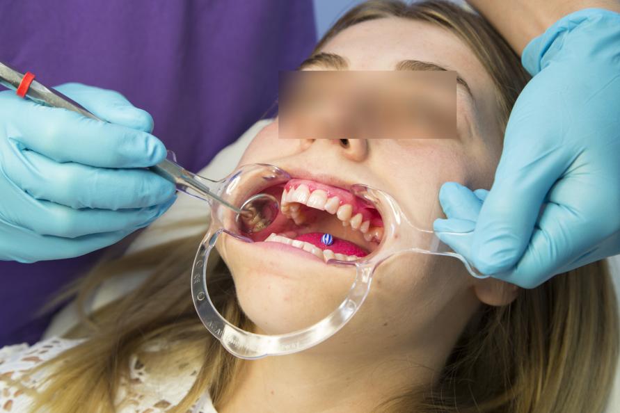 Tandläkaren undersökte mängden plack och tandköttets kondition både före och efter 28 dagars borstning. Foto: Matthieu Colin